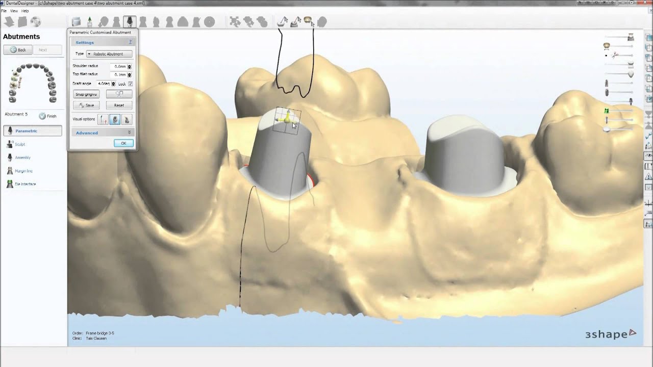 Dental System™ 2010 Abutment Designer YouTube