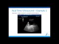 Expert Angle: Pelvic Floor Rehabilitation for Post Prostatectomy Incontinence (3/3) with Bill Landry