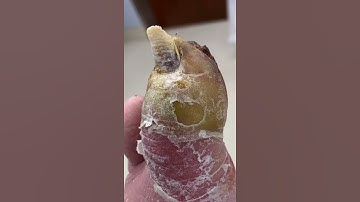 TOE AMPUTATION FROM INFECTION 😳🤯 #shorts #diabetes