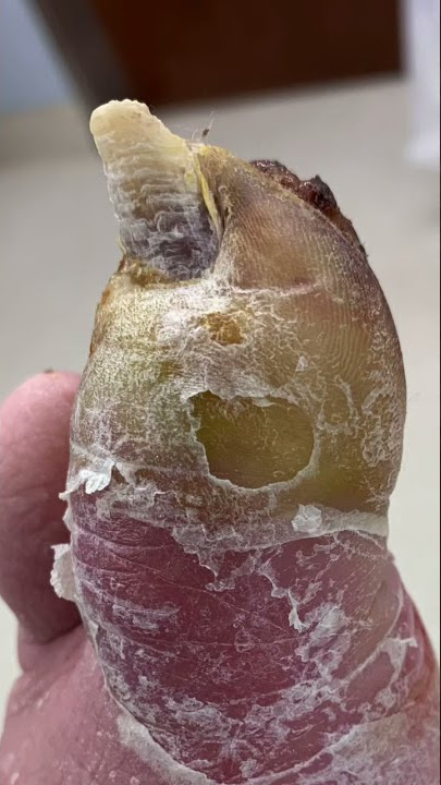 TOE AMPUTATION FROM INFECTION 😳🤯 #shorts #diabetes