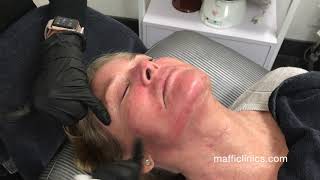 Maffi Clinics: Ultra Pure PRP Facial