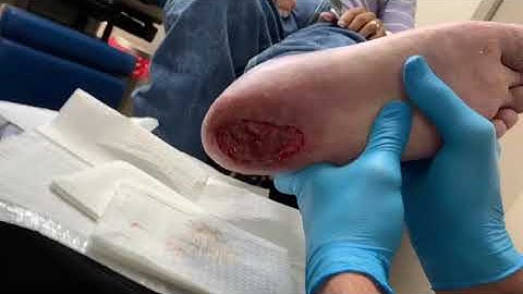 BONE BIOPSY PROCEDURE IN OFFICE