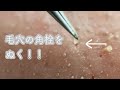 【毛穴】角栓をピンセットで除去します♡