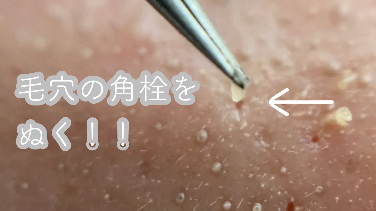 超巨大角栓除去ユーチューブ | 毛穴 角栓 取る 動画 – NRDTX