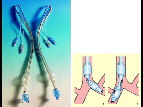 Platzierung eines doppellumigen Trachealtubus