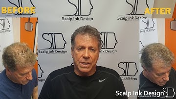 Scalp Micropigmentation in Miami - Joe