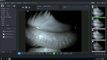 Meibomian Gland Analysis in Mediview