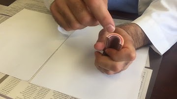 How a spontaneous coronary artery dissection happens, explained by a Novant Health cardiologist.