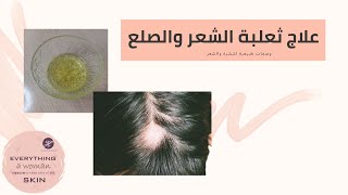 علاج الثعلبة والصلع و إنبات الشعر  @user-ep6yw6pw2j
