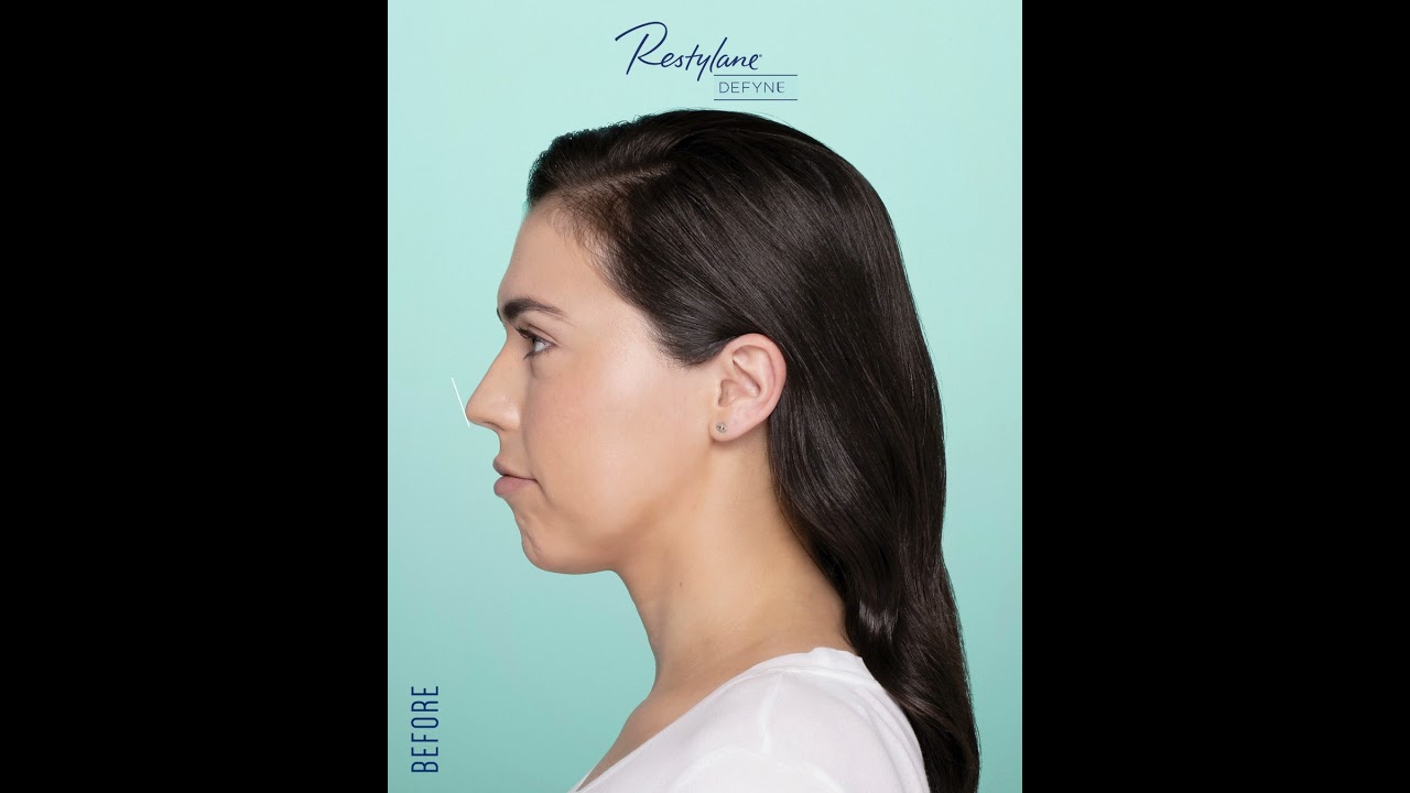 Restylane Defyne- Before and After Morphing Video