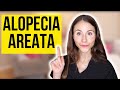 Alopecia Areata Explained | Treatments, Causes, Signs &amp; Symptoms,