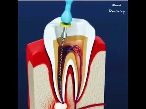 Video: Diş çürüməsini gizlətməyin 3 yolu