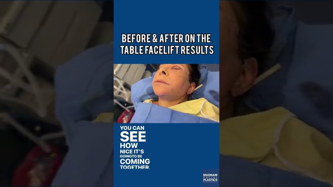 Facelift results of my patient immediately after surgery!