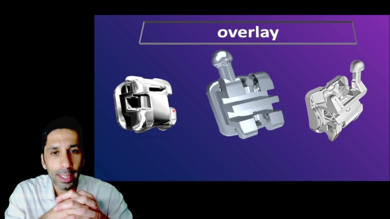 Double SLOT Innovation Bracket in Orthodontic  Biomechanic... Prof Thaer Hamid (Brazil)
