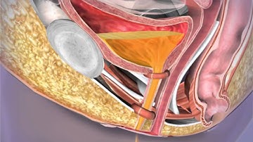 Urinary Incontinence: Learn@Visible Body