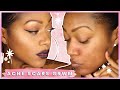 GRWM: COVERING ACNE SCARS + NEUTRAL EYES &amp; BOLD LIPS