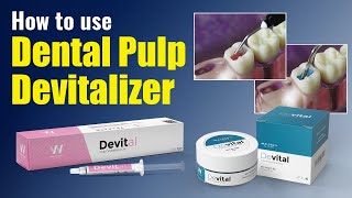 How to use Dental Pulp Devitalizer | Waldent Devital