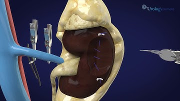 Robot-Assisted Partial Nephrectomy for Kidney Cancer and Benign Kidney Tumors