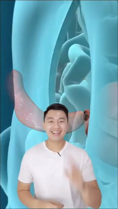 Operasi usus buntu!ada yang pernah mengalami? #ususbuntu #usus #tipskesehatan #kesehatan #viral