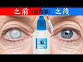 白內障青光眼,最棒2種自然療法!!,柏格醫生 Dr Berg