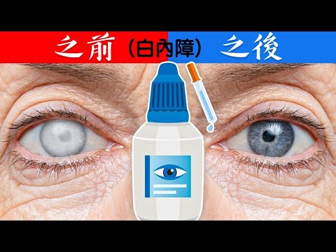 白內障青光眼,最棒2種自然療法!!,柏格醫生 Dr Berg