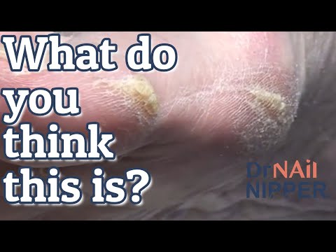 Video: Callus Pyoderma i albuen