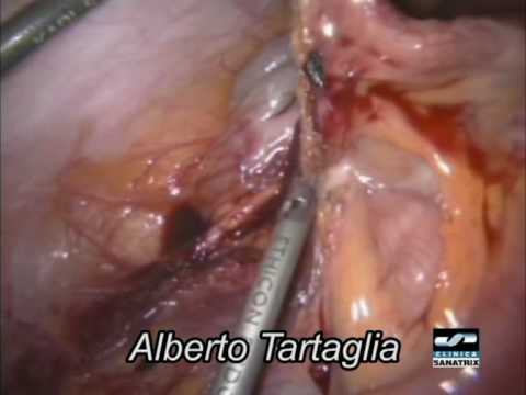 Video: Appendicite Catarrale