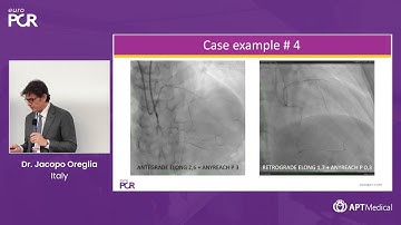 Mastering Retrograde (Septal) Techniques in CTO PCI - Dr. Jacopo Oreglia (Italy)  |  EuroPCR 2025
