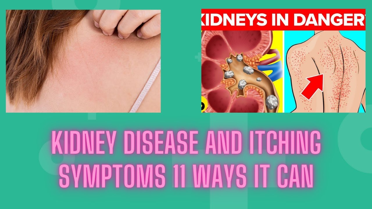Kidney disease and itching symptoms 11 ways it can YouTube