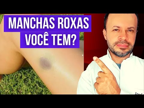 Vídeo: A equimose é um sinal ou sintoma?