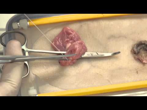 Video: Waar is de incisie voor ileostoma?