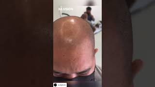Scalp Micro Pigmentation (SMP)Amazing before nd after results😍#celebritysurgeon!by DR VARUN NAMBIAR