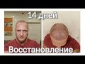 14 дней после пересадки волос. Этап восстановления.