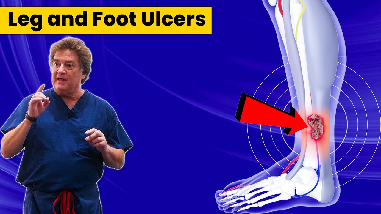 Leg and Foot Ulcers Kaplan Surgery YouTube