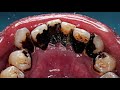 Black Tartar On Smoker’s Teeth | Dentist | Dokter Gigi Tri Putra