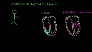 Ventriküler Taşikardi Vt Fen Bilimleri Sağlık Ve Tıp