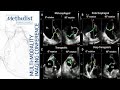 Multi-Modality Case Presentations: by Advanced CV Imaging Fellows (Dipan J. Shah, MD) May 24, 2022