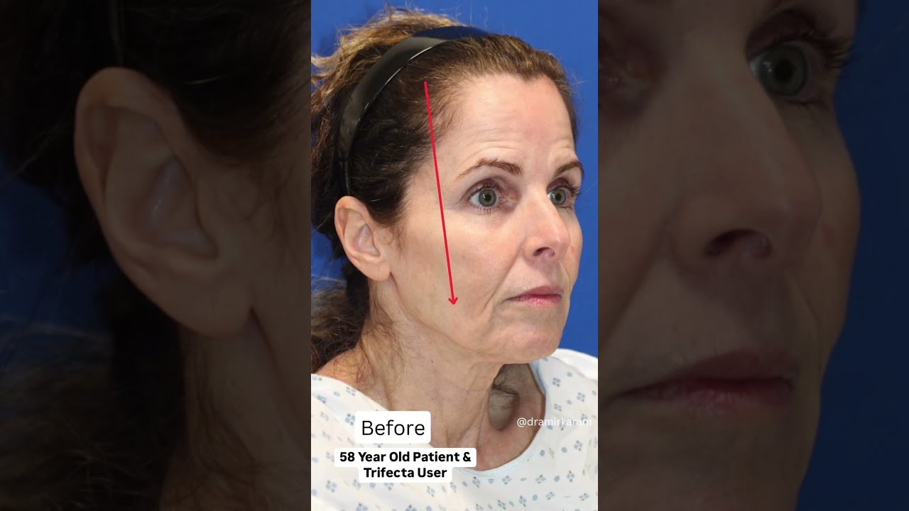 58 Year Old LOOKS 20 YEARS YOUNGER Facelift Before After 