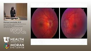Uncommon Cases in Pediatric Uveitis [ARCHIVE]