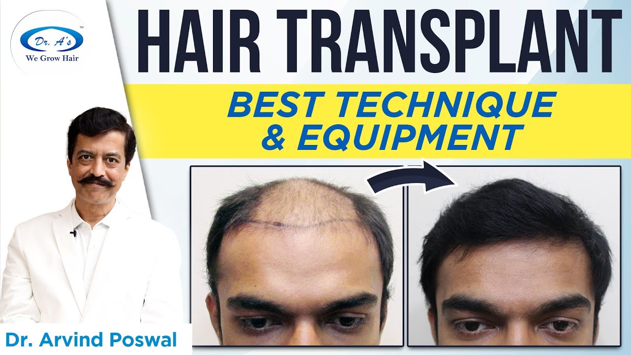 ⚡ Hair Transplant Best Technique & Equipment | 💹Hair Transplant Surgery in  Delhi | Dr. A's Clinic - YouTube