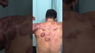 Hạn chế vận động khớp vai