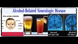 Alcohol Related Neurologic Disease.امراض المخ والاعصاب التى يسببها الخمر والكحول