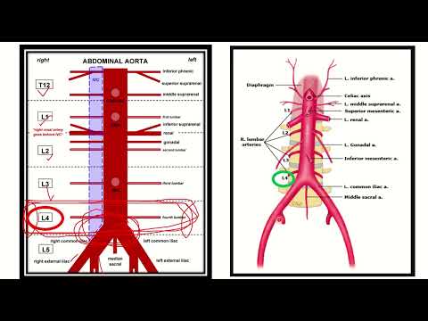 Abdominal aorta bifurcation vertebral level MRCS question solve (CRACK MRCS)