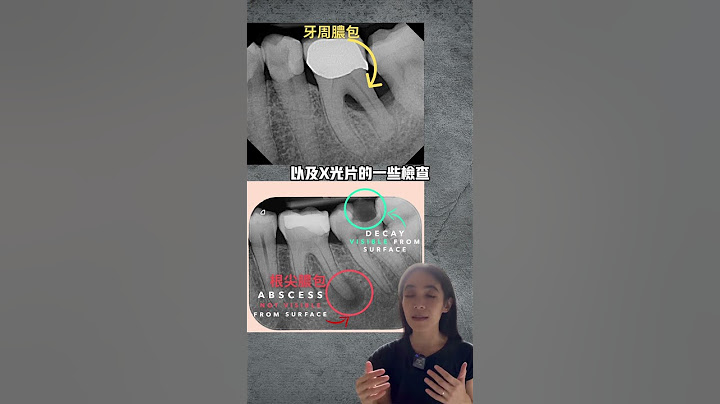 牙龈长脓包一定要根管治疗吗#根尖脓包#牙周脓包 - 天天要闻