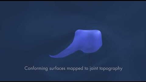 ConforMIS iFit: Image-to-Implant Technology