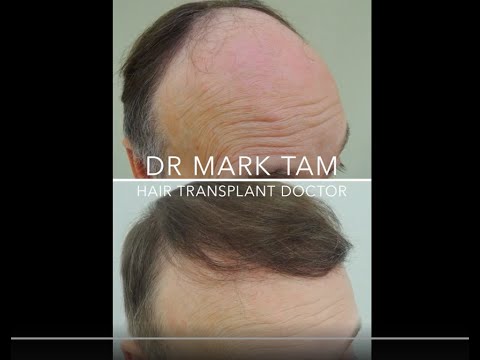 Frontal area hair
