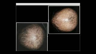 Dermoscopy of cicatricial alopecia 2: Dr/ Rania Al Akad