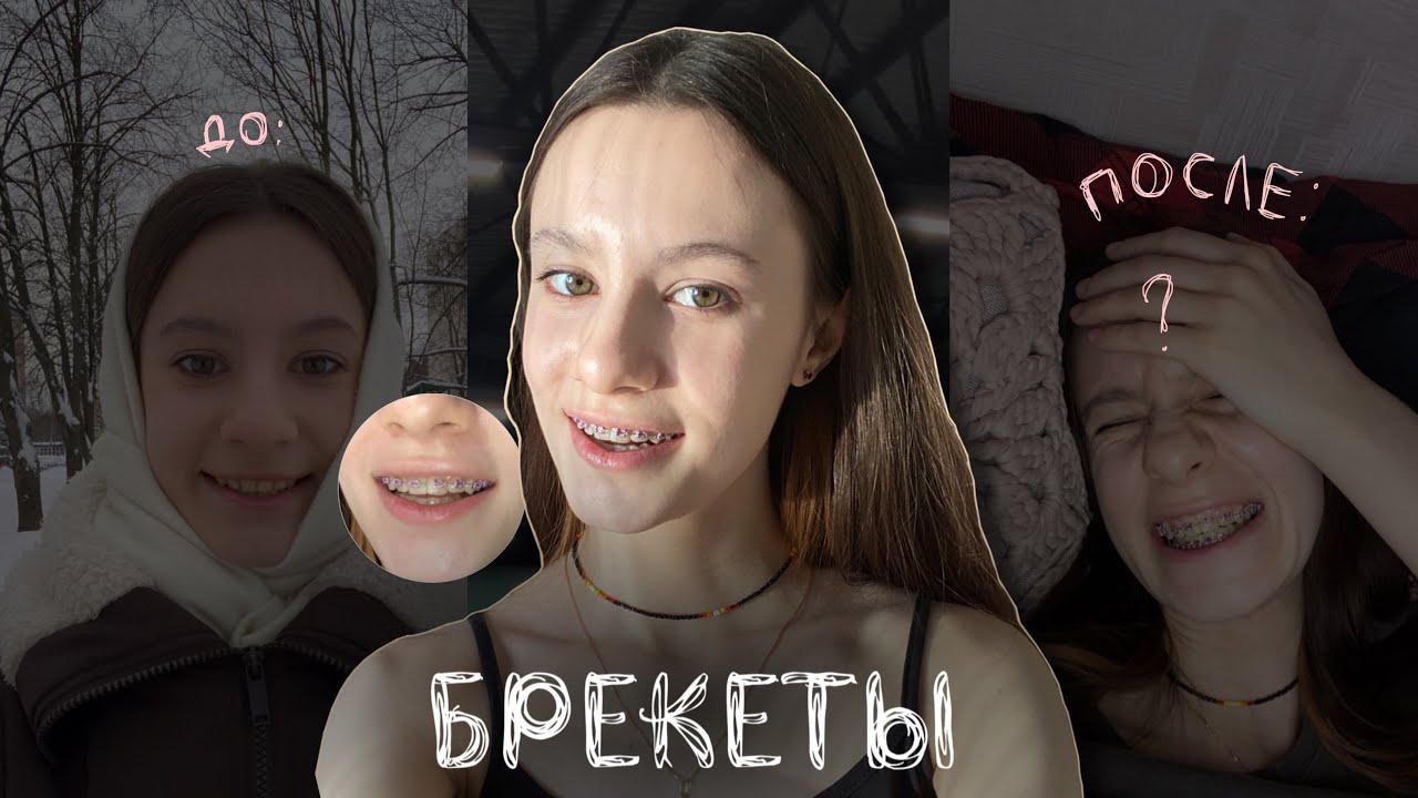 влог: мне поставили брекеты ✨