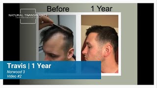 Stronger Hairline, Stronger Confidence: 1-Year Hair Transplant Progress | Dr. Blumenthal (Travis) @naturaltransplantsclinic