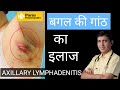     axillary lymphadenitis  armpit lymph nodes swollen  swollen lymph nodes treatment